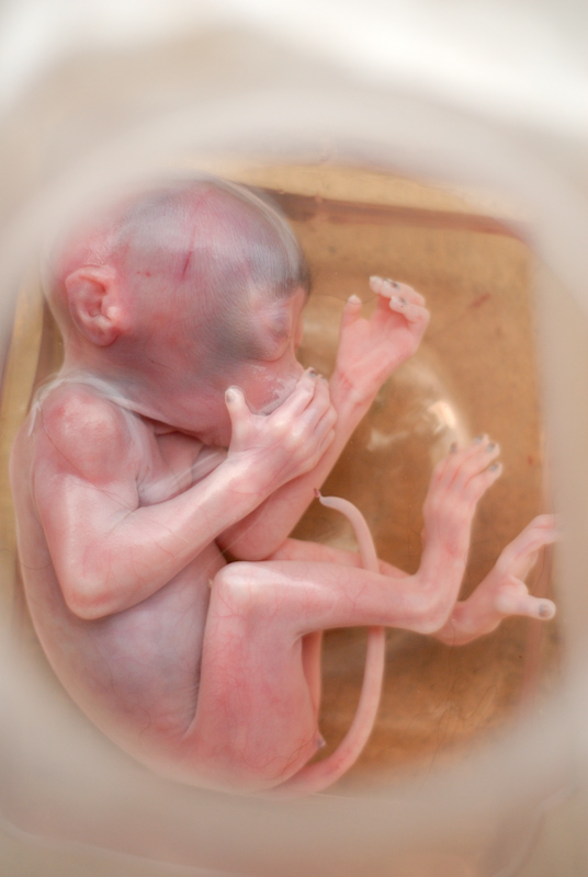 LTM - fetus
